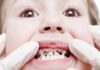 Серебрение зубов у детей
