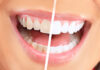 Для чего необходимо отбеливание зубов?