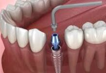 Установка металлокерамической коронки