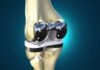 Эндопротезирование коленного сустава: современный метод хирургического лечения колена