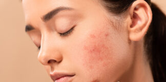 Причины появления акне