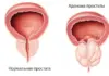 Симптомы и лечение аденомы предстательной железы: что важно знать каждому мужчине