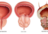 Лечение аденомы предстательной железы: что нужно знать каждому мужчине